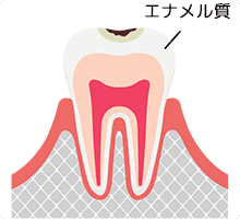 軽度のむし歯