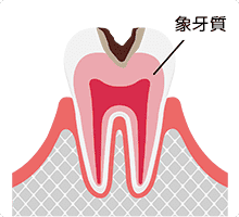 中度のむし歯