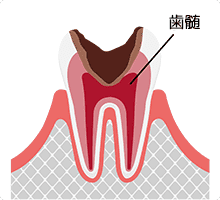 重度のむし歯