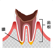 最重度のむし歯