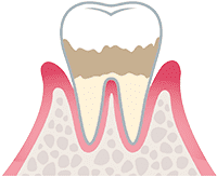 軽度歯肉炎