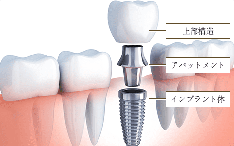 インプラントの構造
